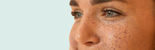Discoloration