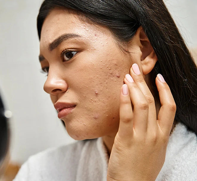 Acne-Prone Skin